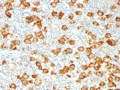 Immunohistochemistry-Paraffin: CD30/TNFRSF8 Antibody (Ki-1/1505R) [NBP2-53309] - Formalin-fixed, paraffin-embedded human Hodgkin's Lymphoma stained with CD30 Recombinant Rabbit Monoclonal Antibody (Ki-1/1505R).