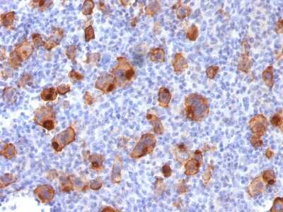 Immunohistochemistry-Paraffin: CD30/TNFRSF8 Antibody (Ki-1/1747R) [NBP2-54556] - Formalin-fixed, paraffin-embedded human Hodgkin's Lymphoma stained with CD30 Recombinant Rabbit Monoclonal Antibody (Ki-1/1747R).