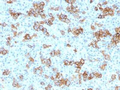 Immunohistochemistry-Paraffin: CD30/TNFRSF8 Antibody (Ki-1/779) - IHC-Prediluted [NBP2-48271] - Human Hodgkin's Lymphoma stained with CD30 Monoclonal Antibody (Ki-1/779).