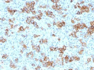 Immunohistochemistry-Paraffin: CD30/TNFRSF8 Antibody (Ki-1/779) [NBP2-44561] - Formalin-fixed, paraffin-embedded human Hodgkin's Lymphoma stained with CD30/TNFRSF8 Antibody (Ki-1/779).