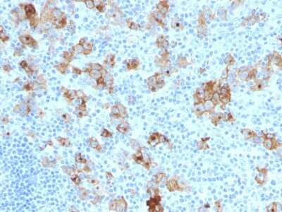 Immunohistochemistry-Paraffin: CD30/TNFRSF8 Antibody (SPM121) [NBP2-44560] - Formalin-fixed, paraffin-embedded human Hodgkin's Lymphoma stained with CD30/TNFRSF8 Antibody (SPM121).