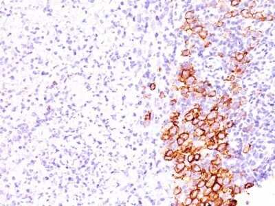 Immunohistochemistry-Paraffin: CD30/TNFRSF8 Antibody (SPM609) - Azide and BSA Free [NBP2-47907] - Human Hodgkin's Lymphoma stained with CD30 Monoclonal Antibody (SPM609).