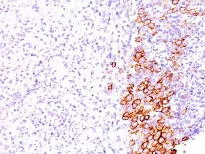 Immunohistochemistry-Paraffin: CD30/TNFRSF8 Antibody (SPM609) [NBP2-44562] - Human Hodgkin's Lymphoma stained with CD30 Monoclonal Antibody (SPM609).