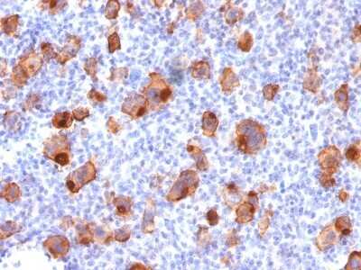 Immunohistochemistry-Paraffin: CD30/TNFRSF8 Antibody (rKi-1/779) [NBP2-53300] - Formalin-fixed, paraffin-embedded human Hodgkin's Lymphoma stained with CD30 Recombinant Mouse Monoclonal Antibody (rKi-1/779).