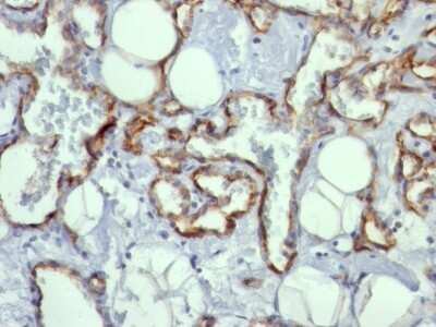 Immunohistochemistry-Paraffin: CD31/PECAM-1 Antibody (C31.10) [NBP2-44340] - Human Angiosarcoma stained with CD31/PECAM-1 Antibody (C31.10).