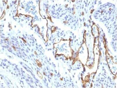 Immunohistochemistry-Paraffin: CD31/PECAM-1 Antibody (C31/1395R) - Azide and BSA Free [NBP2-54385] - Formalin-fixed, paraffin-embedded human Angiosarcoma stained with CD31/PECAM-1 Antibody (C31/1395R) - Azide and BSA Free.