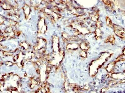 Immunohistochemistry-Paraffin: CD31/PECAM-1 Antibody (C31.3 + C31.7 + C31.10) - Azide and BSA Free [NBP2-47785] - Formalin-fixed, paraffin-embedded Angiosarcoma stained with CD31/PECAM-1 Antibody (C31.3 + C31.7 + C31.10) - Azide and BSA Free.