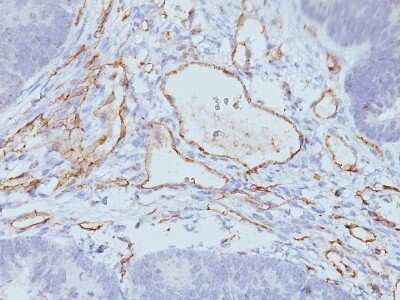 Immunohistochemistry-Paraffin: CD31/PECAM-1 Antibody (C31.3 + C31.7 + C31.10) - Azide and BSA Free [NBP2-47785] - Colon Carcinoma stained withCD31/PECAM-1 Antibody (C31.3 + C31.7 + C31.10) - Azide and BSA Free.