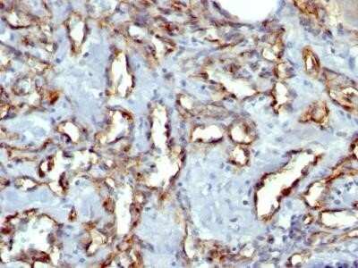 Immunohistochemistry-Paraffin: CD31/PECAM-1 Antibody (C31.3 + JC/70A) - Azide and BSA Free [NBP2-34578] - Formalin-paraffin human Angiosarcoma stained with CD31/PECAM-1 Antibody (C31.3 + JC/70A) - Azide and BSA Free.
