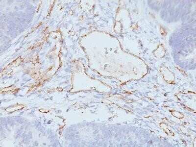 Immunohistochemistry-Paraffin: CD31/PECAM-1 Antibody (C31.3 + JC/70A) - IHC-Prediluted [NBP2-44336] - Formalin-paraffin human Colon Carcinoma stained with CD31/PECAM-1 Antibody (C31.3 + JC/70A) - IHC-Prediluted.