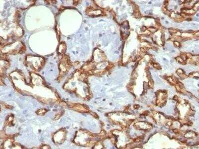 Immunohistochemistry-Paraffin: CD31/PECAM-1 Antibody (C31.3) - IHC-Prediluted [NBP2-44334] - Analysis using Azide/BSA FREE version of CD31/PECAM-1 Antibody (C31.3) - IHC-Prediluted. Formalin-paraffin human Angiosarcoma stained with CD31 MAb (C31.3).