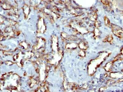 Immunohistochemistry-Paraffin: CD31/PECAM-1 Antibody (C31.7) - Azide and BSA Free [NBP2-33136] - Formalin-paraffin human Angiosarcoma stained with CD31/PECAM-1 Antibody (C31.7) - Azide and BSA Free.