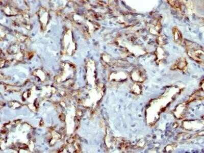 Immunohistochemistry-Paraffin: CD31/PECAM-1 Antibody (C31.7) - IHC-Prediluted [NBP2-44333] - Analysis using Azide/BSA FREE version of CD31/PECAM-1 Antibody (C31.7) - IHC-Prediluted. Formalin-paraffin human Angiosarcoma stained with CD31 MAb (C31.7).