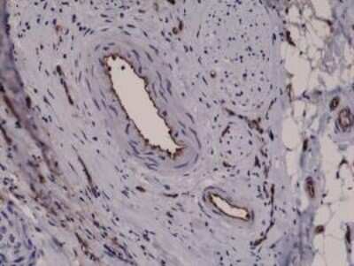 Immunohistochemistry-Paraffin: CD31/PECAM-1 Antibody (RM247) [NBP2-61509] - Immunohistochemical staining of formalin fixed and paraffin embedded human breast cancer tissue sections using CD31/PECAM-1 Antibody (RM247).