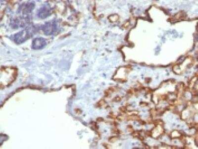 Immunohistochemistry-Paraffin: CD31/PECAM-1 Antibody (SPM122) [NBP2-32930] - Formalin-fixed, paraffin-embedded human Angiosarcoma stained with CD31/PECAM-1 Antibody (SPM122).