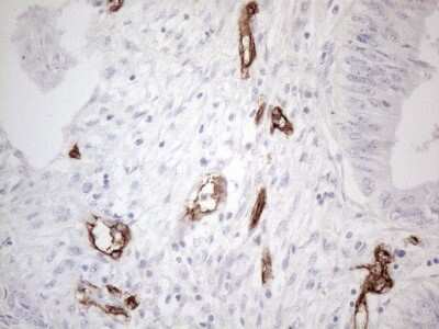 Immunohistochemistry: CD34 Antibody (11E1) [NBP2-46144] - Analysis of Adenocarcinoma of Human colon tissue. (Heat-induced epitope retrieval by 1mM EDTA in 10mM Tris buffer (pH8.5) at 120C for 3 min)