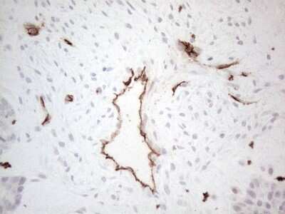 Immunohistochemistry: CD34 Antibody (11E1) [NBP2-46144] - Analysis of Adenocarcinoma of Human endometrium tissue. (Heat-induced epitope retrieval by 1mM EDTA in 10mM Tris buffer (pH8.5) at 120C for 3 min)