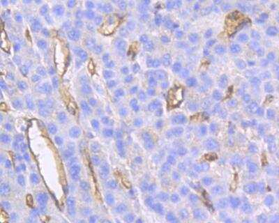 Immunohistochemistry-Paraffin: CD34 Antibody (15H1) [NBP2-89157] - Analysis of paraffin-embedded human liver carcinoma tissue using anti-CD34 antibody. The section was pre-treated using heat mediated antigen retrieval with Tris-EDTA buffer (pH 8.0-8.4) for 20 minutes.The tissues were blocked in 5% BSA for 30 minutes at room temperature, washed with ddH2O and PBS, and then probed with the primary antibody( 1/50) for 30 minutes at room temperature. The detection was performed using an HRP conjugated compact polymer system. DAB was used as the chromogen. Tissues were counterstained with hematoxylin and mounted with DPX.