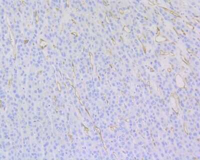 Immunohistochemistry-Paraffin: CD34 Antibody (15H1) [NBP2-89157] - Analysis of paraffin-embedded human liver carcinoma tissue using anti-CD34 antibody. The section was pre-treated using heat mediated antigen retrieval with Tris-EDTA buffer (pH 9.0) for 20 minutes.The tissues were blocked in 1% BSA for 30 minutes at room temperature, washed with ddH2O and PBS, and then probed with the primary antibody (1/200) for 30 minutes at room temperature. The detection was performed using an HRP conjugated compact polymer system. DAB was used as the chromogen. Tissues were counterstained with hematoxylin and mounted with DPX.