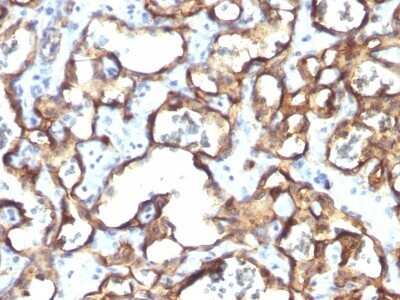 Immunohistochemistry-Paraffin: CD34 Antibody (HPCA1/1171) - Azide and BSA Free [NBP2-47911] - Human Angiosarcoma stained with CD34 Monoclonal Antibody (HPCA1/1171)