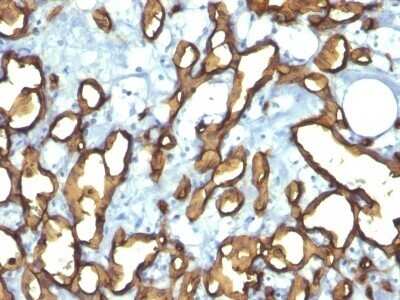 Immunohistochemistry-Paraffin: CD34 Antibody (HPCA1/763) - Azide and BSA Free [NBP2-47910] - Human Angiosarcoma stained with CD34 Monoclonal Antibody (HPCA1/763)