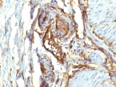 Immunohistochemistry-Paraffin: CD34 Antibody (QBEnd/10 + HPCA1/763) - Azide and BSA Free [NBP2-47909] - Human Colon Carcinoma stained with CD34 Monoclonal Antibody (QBEnd/10 + HPCA1/763)