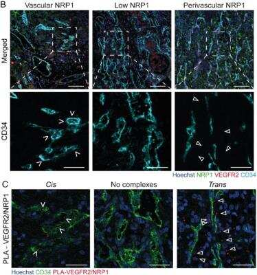 Immunohistochemistry: CD34 Antibody (QBEnd/10 + HPCA1/763) [DyLight 650] [NBP2-44567C] - Representative images of RCC patient biopsies immunostained for VEGFR2, CD34, and NRP1 and counterstained using Hoechst33342. Left column shows examples of NRP1 expressed by endothelial cells; middle column shows a tumor sample with low NRP1 expression. Right column shows NRP1 positive perivascular tumor cells. Blood vessels were stained for CD34 and nuclei counterstained using Hoechst33342. Left column shows cis complexes, localized within the endothelium. Middle column shows a tumor lacking VEGFR2/NRP1 complexes. Right column shows trans complexes, located adjacent to the endothelium (white arrowheads). Image collected and cropped by Citeab from the following publication (Perivascular Neuropilin-1 expression is an independent marker of improved survival in renal cell carcinoma. J Pathol (2020) licensed under a CC-BY license.