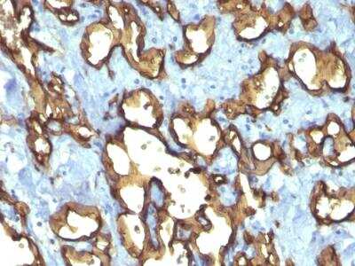 Immunohistochemistry-Paraffin: CD34 Antibody (QBEnd/10 + HPCA1/763) - IHC-Prediluted [NBP2-48362] - Formalin-fixed, paraffin-embedded human Angiosarcoma stained with CD34 Monoclonal Antibody (QBEnd/10 + HPCA1/763).