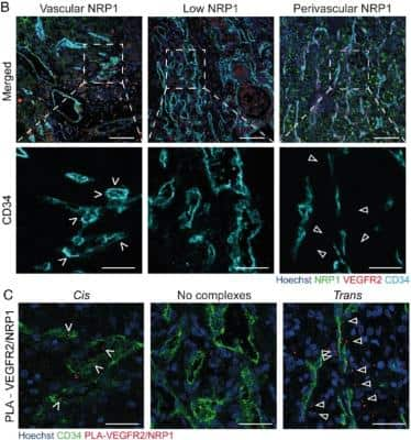 Immunohistochemistry: CD34 Antibody (QBEnd/10 + HPCA1/763) [NBP2-44567] - Representative images of RCC patient biopsies immunostained for VEGFR2, CD34, and NRP1 and counterstained using Hoechst33342. Left column shows examples of NRP1 expressed by endothelial cells; middle column shows a tumor sample with low NRP1 expression. Right column shows NRP1 positive perivascular tumor cells. Blood vessels were stained for CD34 and nuclei counterstained using Hoechst33342. Left column shows cis complexes, localized within the endothelium. Middle column shows a tumor lacking VEGFR2/NRP1 complexes. Right column shows trans complexes, located adjacent to the endothelium (white arrowheads). Image collected and cropped by Citeab from the following publication (Perivascular Neuropilin-1 expression is an independent marker of improved survival in renal cell carcinoma. J Pathol (2020) licensed under a CC-BY license.