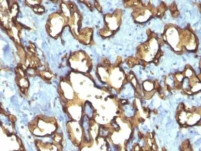 Immunohistochemistry-Paraffin: CD34 Antibody (QBEnd/10 + HPCA1/763) [NBP2-44567] - Human Angiosarcoma stained with CD34 Monoclonal Antibody (QBEnd/10 + HPCA1/763)