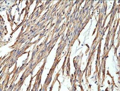 Immunohistochemistry-Paraffin: CD34 Antibody (RM300) [NBP2-61510] - Immunohistochemical staining of formalin fixed and paraffin embedded human gastrointestinal stromal tumor tissue section using NBP2-61510 at a 1:400 dilution.