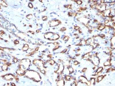 Immunohistochemistry-Paraffin: CD34 Antibody (SPM610) - IHC-Prediluted [NBP2-48364] - Formalin-fixed, paraffin-embedded human Angiosarcoma stained with CD34 Monoclonal Antibody (SPM610).
