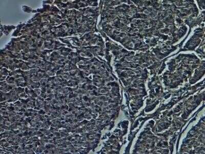 Immunohistochemistry-Frozen: CD38 Antibody (1G7F4) - Azide and BSA Free [NBP2-80645] - Human lung cancer frozen tissue stained with HRP conjugated CD38 antibody (Catalog # NBP2-25265H). IHC-Fr image submitted by a verified customer review.