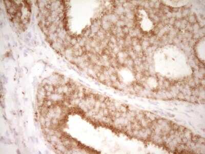 Immunohistochemistry: CD40/TNFRSF5 Antibody (8B8) [NBP2-46150] - Analysis of Adenocarcinoma of Human breast tissue. (Heat-induced epitope retrieval by Tris-EDTA, pH8.0)