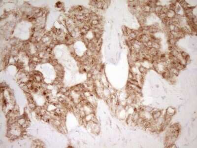 Immunohistochemistry: CD40/TNFRSF5 Antibody (8B8) [NBP2-46150] - Analysis of Carcinoma of Human liver tissue. (Heat-induced epitope retrieval by Tris-EDTA, pH8.0)