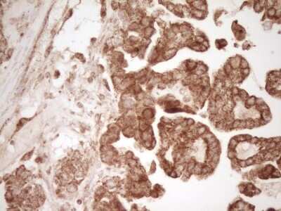 Immunohistochemistry: CD40/TNFRSF5 Antibody (8B8) [NBP2-46150] - Analysis of Adenocarcinoma of Human ovary tissue. (Heat-induced epitope retrieval by Tris-EDTA, pH8.0)