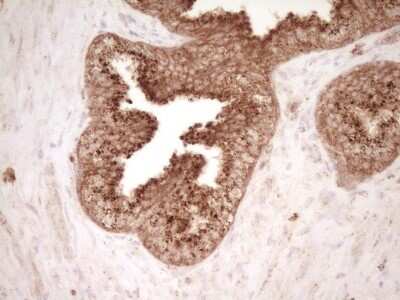 Immunohistochemistry: CD40/TNFRSF5 Antibody (8B8) [NBP2-46150] - Analysis of Adenocarcinoma of Human endometrium tissue. (Heat-induced epitope retrieval by Tris-EDTA, pH8.0)