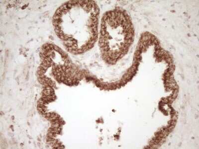 Immunohistochemistry: CD40/TNFRSF5 Antibody (8B8) [NBP2-46150] - Analysis of Carcinoma of Human prostate tissue. (Heat-induced epitope retrieval by Tris-EDTA, pH8.0)