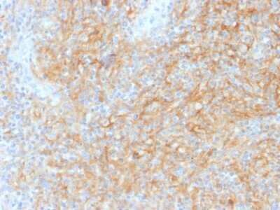 Immunohistochemistry-Paraffin: CD40/TNFRSF5 Antibody (C40/1605) - Azide and BSA Free [NBP2-54502] - Formalin-fixed, paraffin-embedded human Hodgkin?s Lymphoma stained with CD40/TNFRSF5 Antibody (C40/1605).