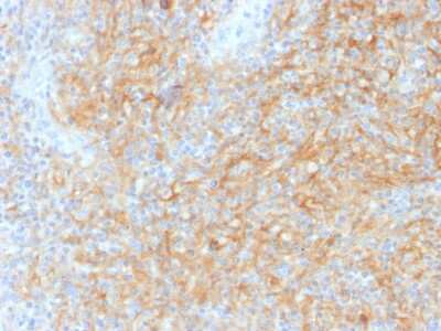 Immunohistochemistry-Paraffin: CD40/TNFRSF5 Antibody (C40/1605) [NBP2-53389] - Formalin-fixed, paraffin-embedded human Hodgkin?s Lymphoma stained with CD40/TNFRSF5 Antibody (C40/1605).