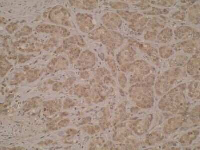 Immunohistochemistry: CD40/TNFRSF5 Antibody (T8P2G4/A6) [NBP2-50284] - Analysis of CD40 in a cross section of human breast cancer tissue. Positive cytoplasmic staining is shown.