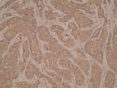 Immunohistochemistry-Paraffin: CD40/TNFRSF5 Antibody (T8P2G4/A6) [NBP2-50284] - Analysis of CD40 in a hepatocellular carcinoma tissue cross section.