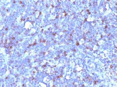 Immunohistochemistry-Paraffin: CD43/Sialophorin Antibody (SPN/1094) - IHC-Prediluted [NBP2-48394] - Formalin-fixed, paraffin-embedded human Lymphoma stained with CD43 Mouse Monoclonal Antibody (SPN/1094).
