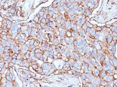 Immunohistochemistry-Paraffin: CD44 Antibody (156-3C11) - Azide and BSA Free [NBP2-34520] - Formalin-paraffin human breast carcinoma stained with CD44 MAb (156-3C11)
