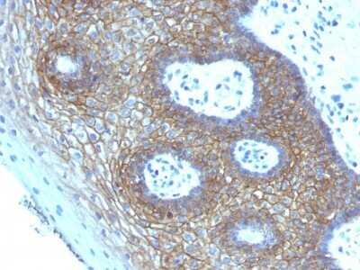 Immunohistochemistry-Paraffin: CD44 Antibody (CD44v4/1219) - variant 4 - Azide and BSA Free [NBP2-54581] - Formalin-paraffin human Cervical Squamous Cell Carcinoma stained with CD44v4 Monoclonal Antibody (CD44v4/1219)