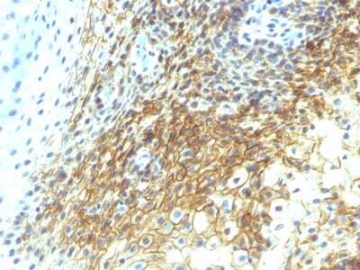 Immunohistochemistry-Paraffin: CD44 Antibody (CD44v4/1219) - variant 4 - Azide and BSA Free [NBP2-54581] - Formalin-paraffin human Tongue Squamous Cell Carcinoma stained with CD44v4 Monoclonal Antibody (CD44v4/1219)