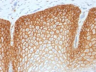 Immunohistochemistry-Paraffin: CD44 Antibody (CD44v4/1700R) - variant 4 [NBP2-53205] - Formalin-paraffin human Cervical Squamous Cell Carcinoma stained with CD44v4 Recombinant Rabbit Monoclonal Antibody (CD44v4/1700)