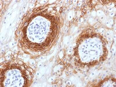 Immunohistochemistry-Paraffin: CD44 Antibody (CD44v6/1246) [NBP2-54572] - Formalin-paraffin human Tongue Carcinoma stained with CD44v6 Monoclonal Antibody (CD44v6/1246)