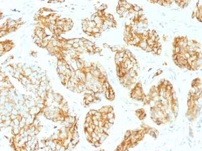 Immunohistochemistry-Paraffin: CD44 Antibody (CD44v9/1459) [NBP2-54571] - Formalin-paraffin human Prostate Carcinoma stained with CD44 Monoclonal Antibody (CD44v9/1459)