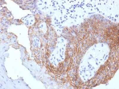 Immunohistochemistry-Paraffin: CD44 Antibody (CD44v9/1459) - variant 9 [NBP2-53204] - Formalin-fixed, paraffin-embedded human Tongue Carcinoma stained with CD44 Antibody (CD44v9/1459) - variant 9.